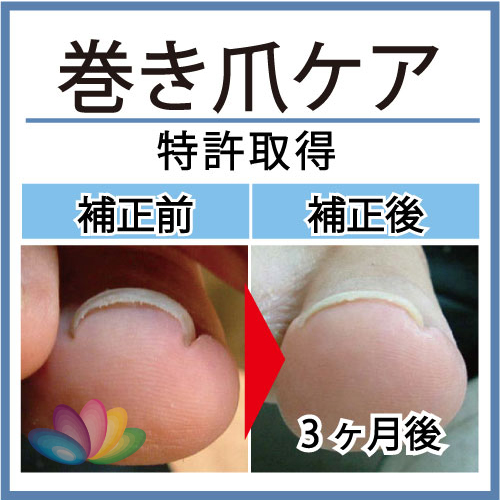 巻き爪ケア