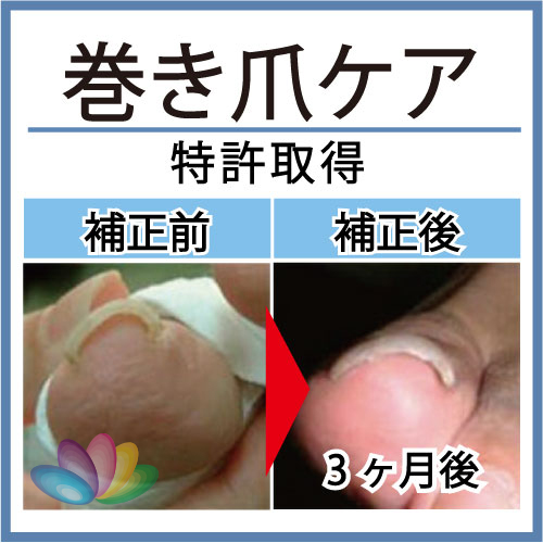 巻き爪ケア